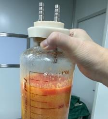 安庆水动力吸脂手术要做多久？